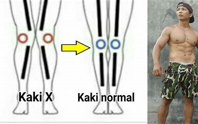  Sobat Yogayuk, Apa Itu Bentuk Kaki X? 